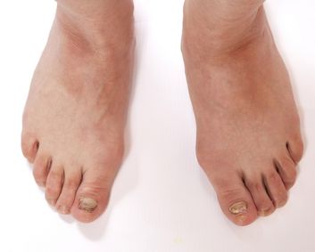 Laser and Fungal Nails at Medical Foot Care Podiatry